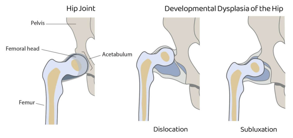 دیسپلازی رشدی مفصل ران چیست؟