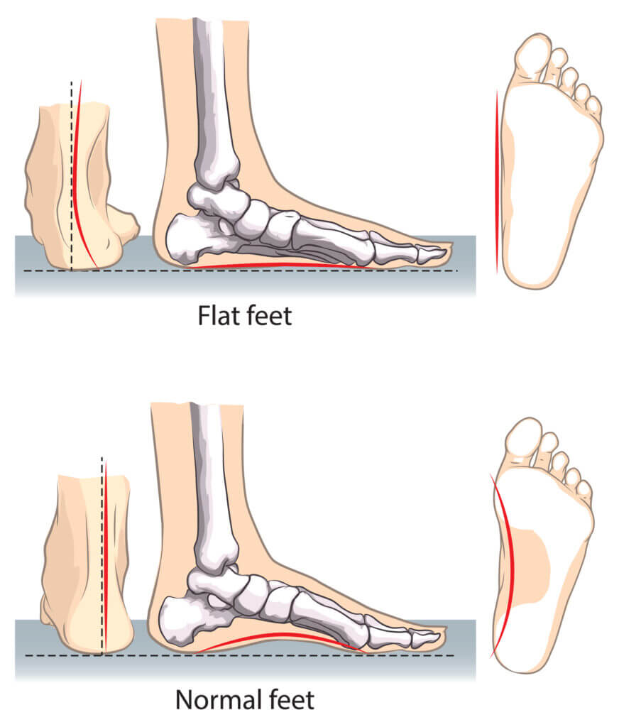 علل ایجاد کف پای صاف چیست؟