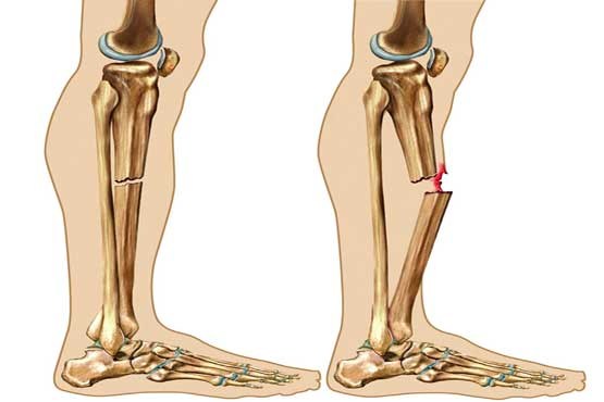 درمان شکستگی ساق پا با روش‌های غیرجراحی