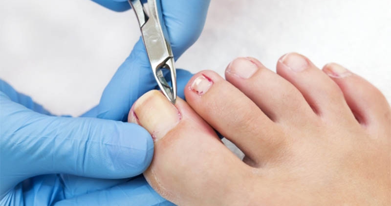 بهترین روش درمان فرو رفتن ناخن در گوشت انگشت پا